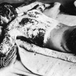 Victim_of_Atomic_Bomb_002
